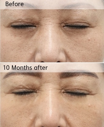 하안검 눈밑지방재배치 재수술, 수술 전후로 살펴봅니다 관련 이미지 3