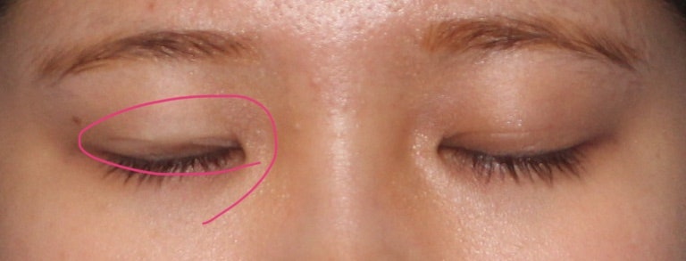 눈재수술이 적절한 시기는 언제일까요? 재수술전 쌍꺼풀 테이프 사용을 해도될까요? 관련 이미지 3