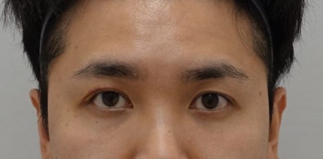 남자 돌출 눈 짝짝이 교정 잘하는 곳, 안검하수 짝짝이 안성민성형외과 관련 이미지 7