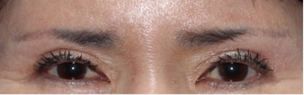 눈썹하거상 후 눈썹 모양, 눈썹하거상 부작용을 겪지 않으려면?잠실성형외과 관련 이미지 4