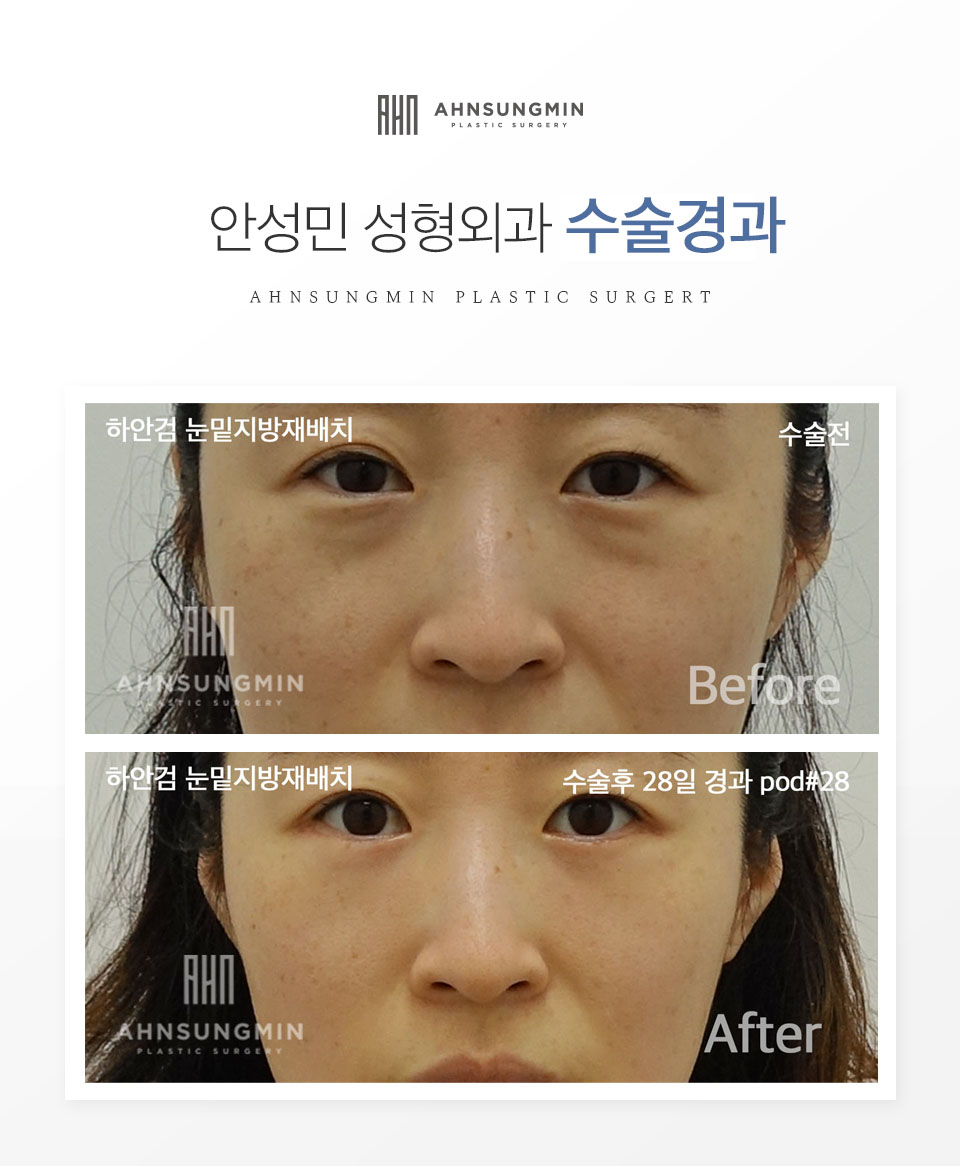 [안성민 성형외과]하안검지방재배치 고객님입니다^^ 관련 이미지 1