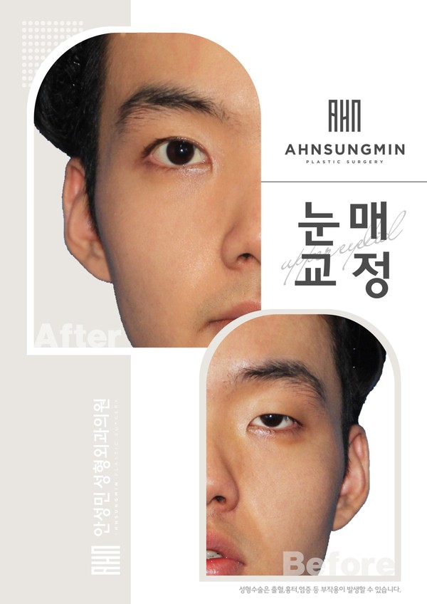 설마..내눈도 안검하수? 관련 이미지 2