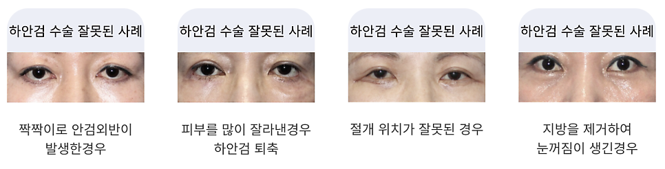 하안검 수술과 중안면 거상의 모든 것 관련 이미지 4