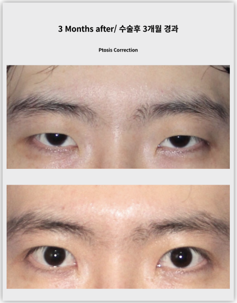 20대 중증 안검하수 수술 후 3개월 경과 관련 이미지 6