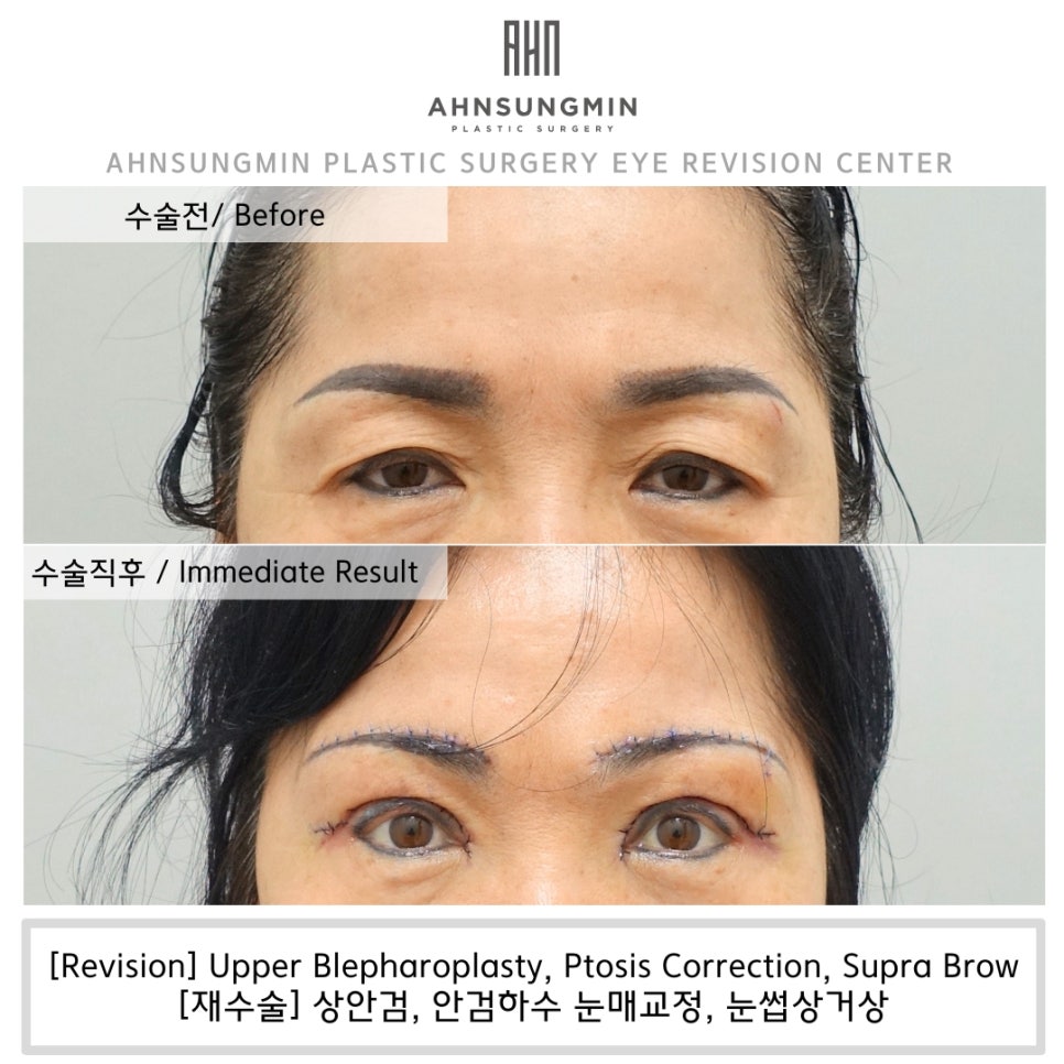 눈썹거상이 왜 필요할까? 눈썹상거상 전문 안성민성형외과 관련 이미지 1