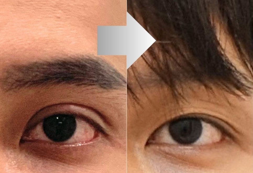 소세지눈 때문에 고민이셨나요? 쌍꺼풀을 낮추고 자연스러운 남성 눈매를 되찾은 4년 후 사례 관련 이미지 1