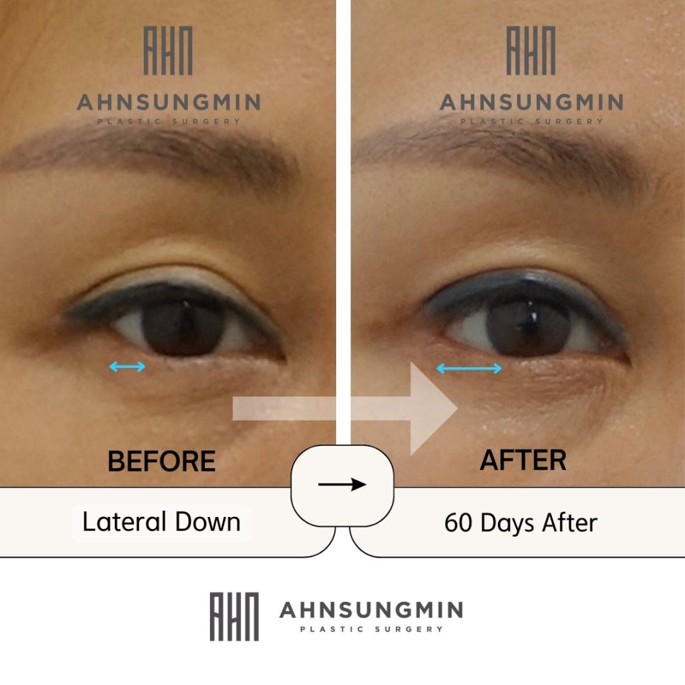 눈밑트임 뒷트임과 뒷내림 [성형외과 전문의 안성민] 관련 이미지 3