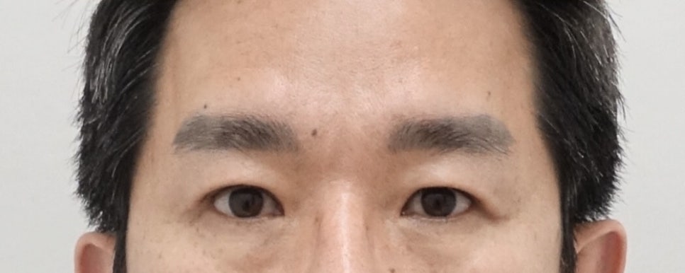 나이대별 상안검 수술 전후, 성형외과전문의 안성민 관련 이미지 10