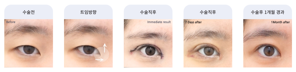 앞트임 수술이란? 내안각 교정술 Epicanthoplasty, 몽고주름 앞트임 성형술 관련 이미지 7