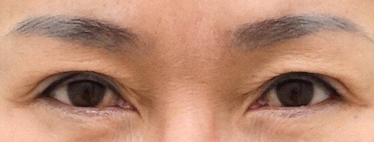 왜 쌍꺼풀이 눌려 보일까? 관련 이미지 2