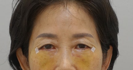 [하안검 재수술의 진실] 하안검도 재수술이 가능할까? 관련 이미지 4