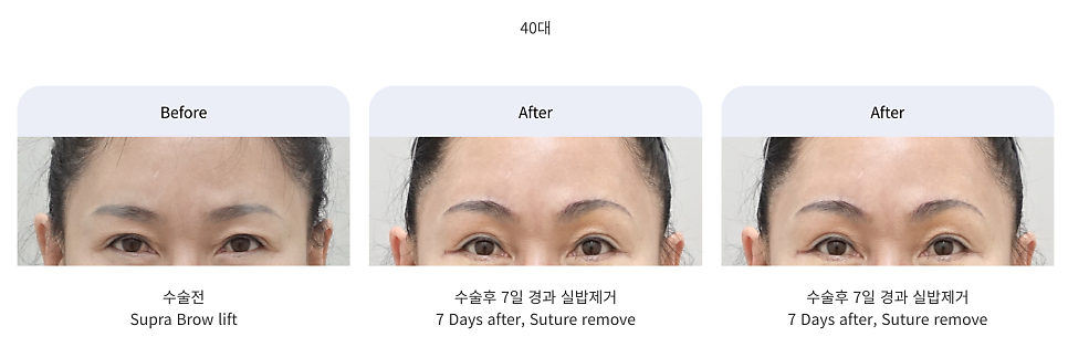 눈썹거상 수술의 장점과 나이대별 회복 과정 관련 이미지 3