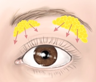 눈꺼풀 꺼짐의 원인과 해결 방법 관련 이미지 1