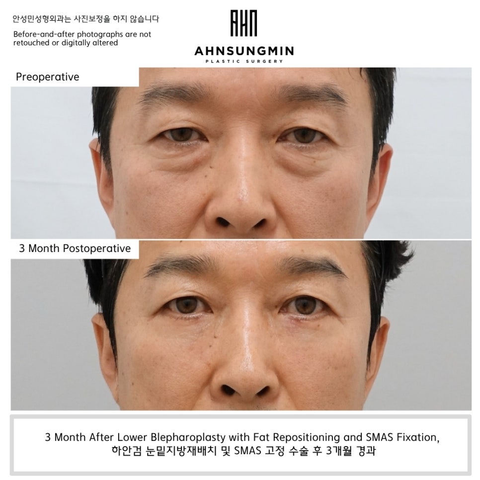 하안검 수술, 결과는 언제부터 자연스러워질까요? 관련 이미지 1