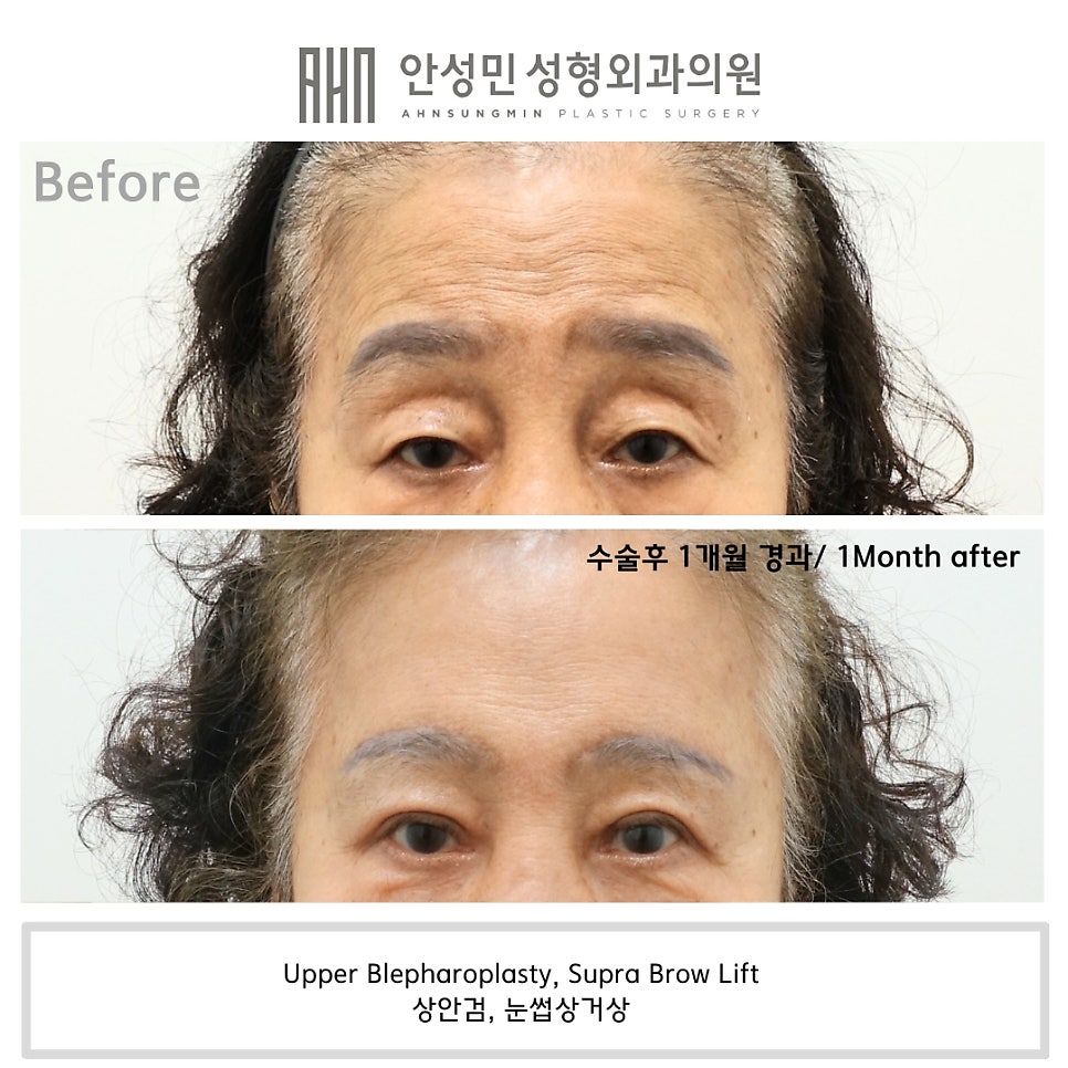 눈썹거상 수술 눈썹상거상 Vs 눈썹하거상 [성형외과 전문의 안성민] 관련 이미지 4