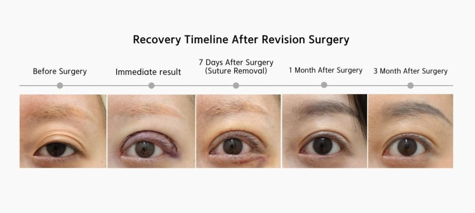 Does Your Eye Still Feel Heavy After Upper Blepharoplasty? image 1