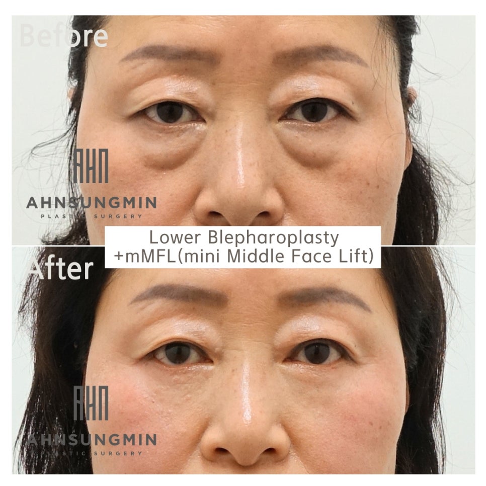 하안검 눈밑지방재배치 수술과 수술시 주의점 관련 이미지 2