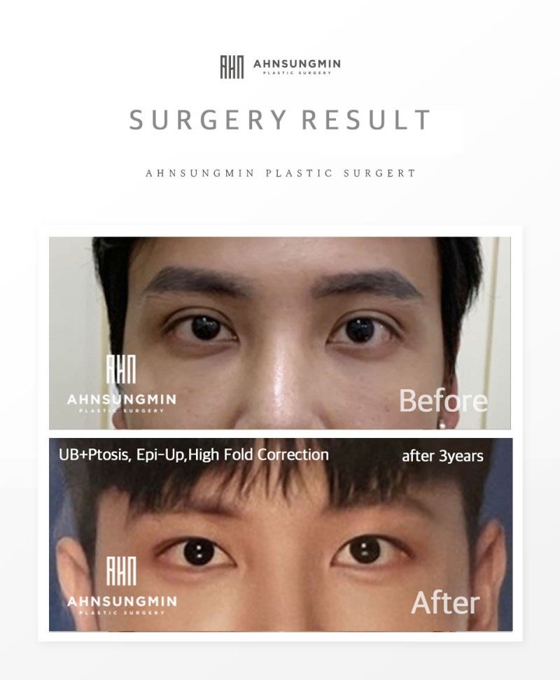 남자 눈재수술 매력적인 무쌍 눈매교정 관련 이미지 6