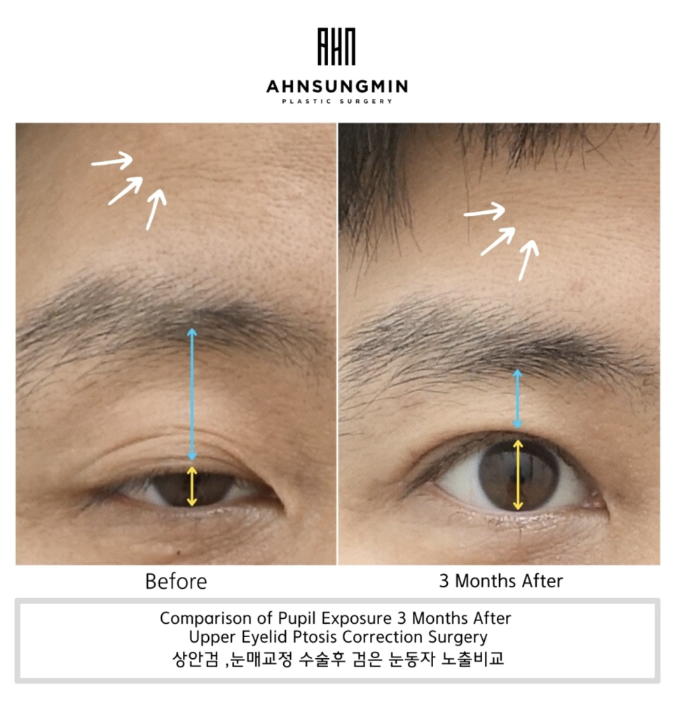 눈매교정이 필요한 경우. 관련 이미지 1