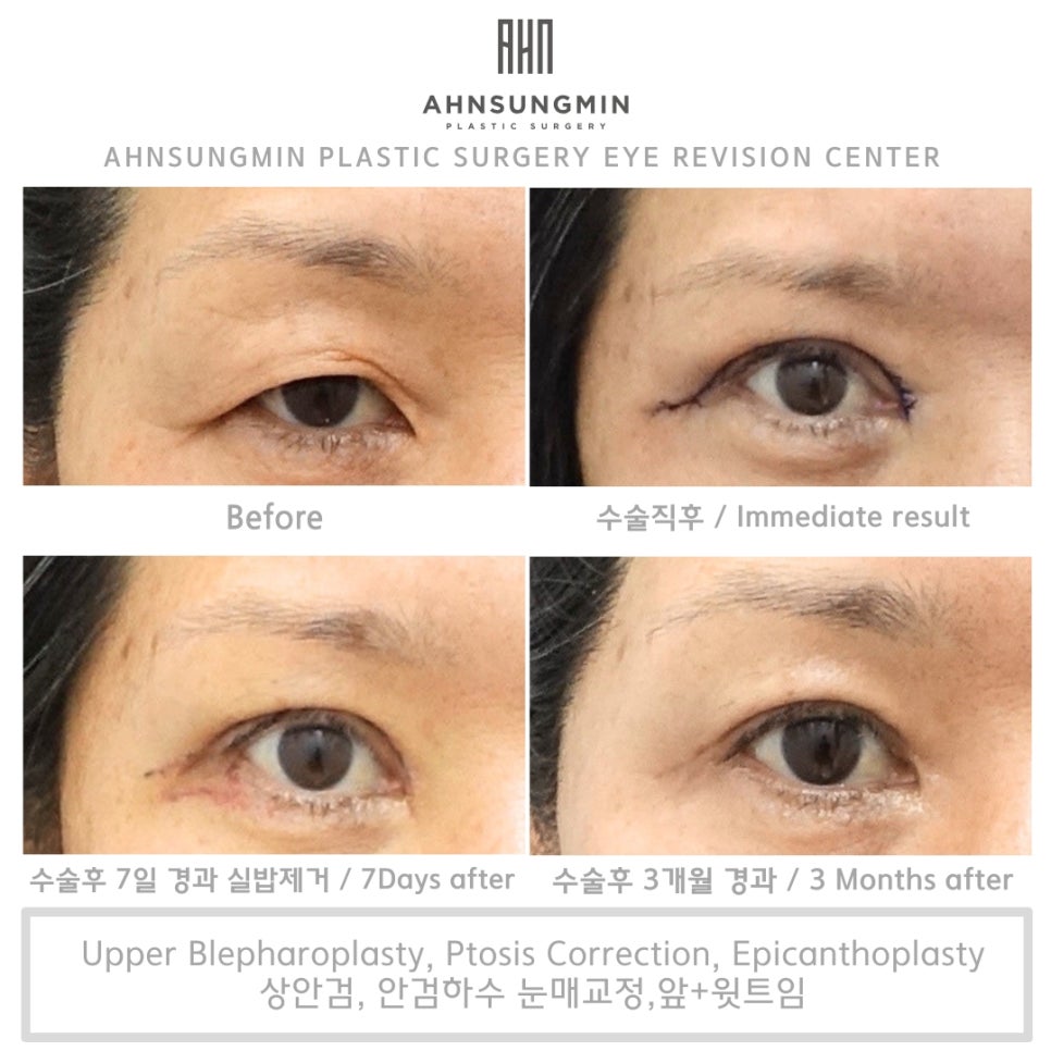 안검하수의 분류, 눈 전문 안성민성형외과 관련 이미지 3