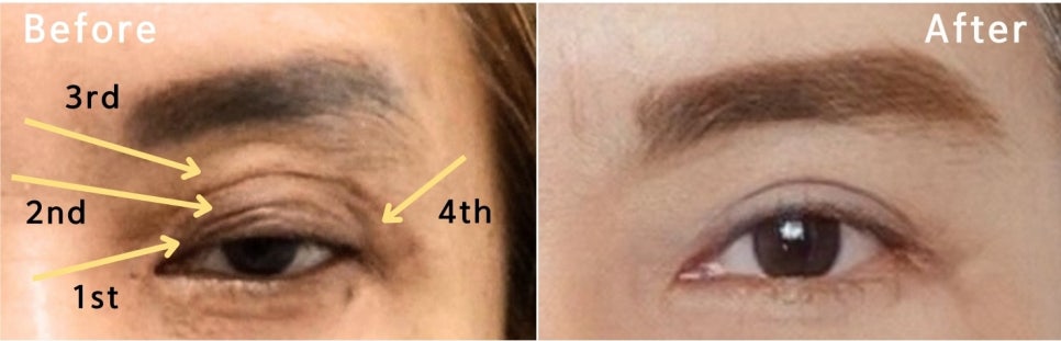 겹주름의 근본적인 원인, 눈 재수술 [성형외과 전문의 안성민] 관련 이미지 3