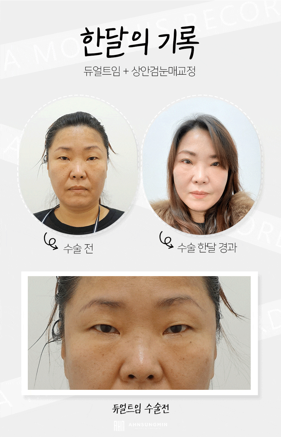 [잠실동성형외과] 듀얼트임 + 상안검눈매교정 한달후기 소개합니다! 잠실성형외과 관련 이미지 1