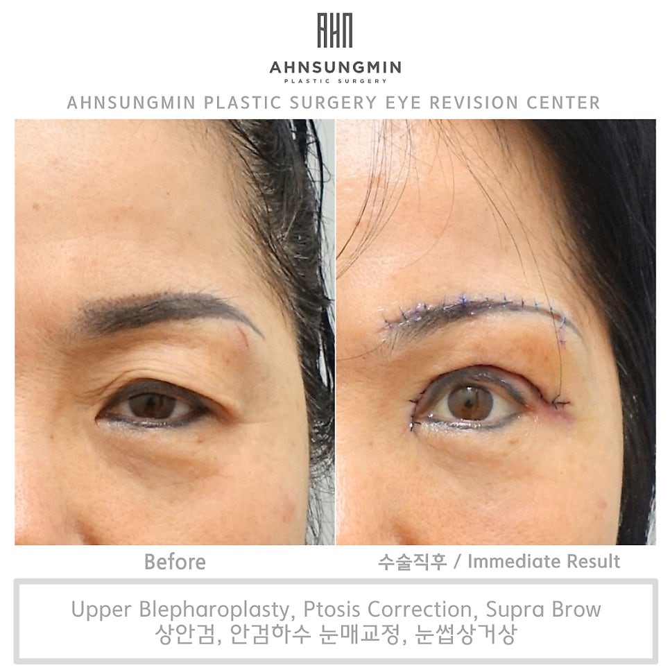 눈썹거상이 왜 필요할까? 눈썹상거상 전문 안성민성형외과 관련 이미지 3
