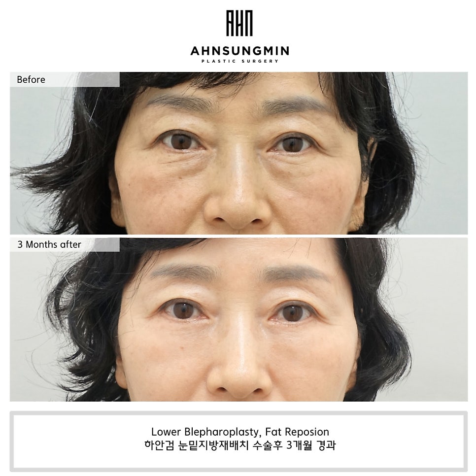 나이대별 눈밑지방재배치 수술 전후 사진 비교 관련 이미지 4