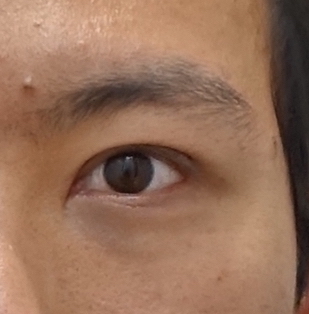 생기있는 남자 눈매완성, 안검하수 눈매교정 관련 이미지 7