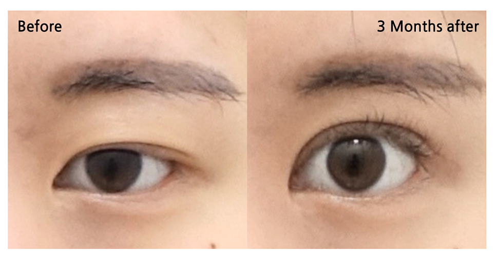 앞트임 수술이란? 내안각 교정술 Epicanthoplasty, 몽고주름 앞트임 성형술 관련 이미지 6