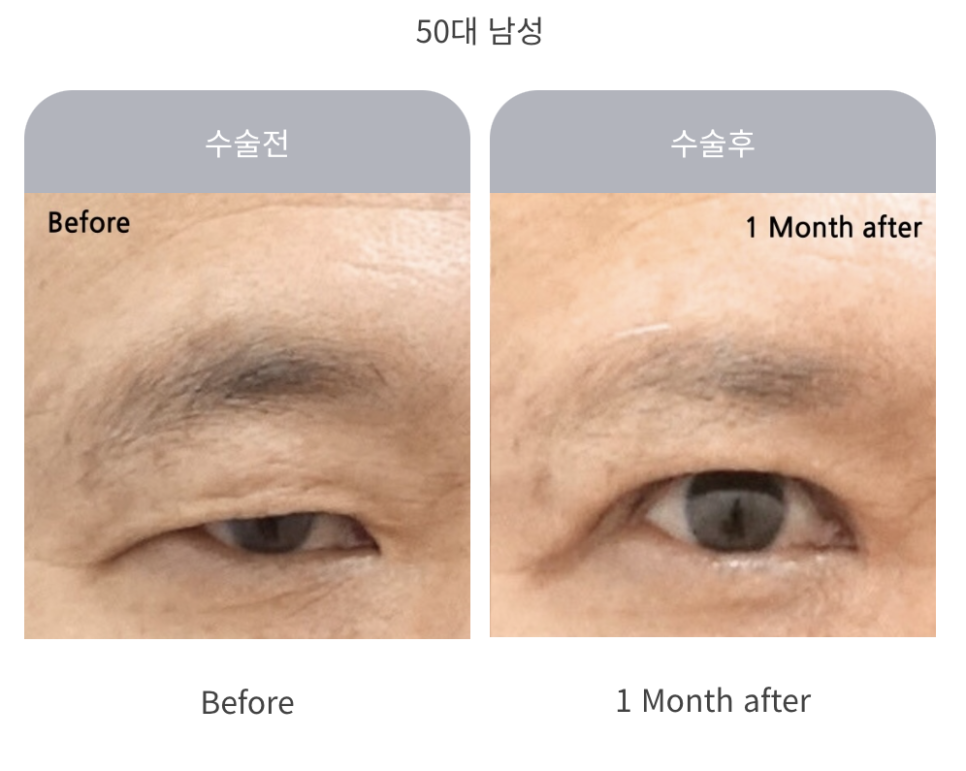 중년 상안검 수술의 특징과 주의사항 관련 이미지 7