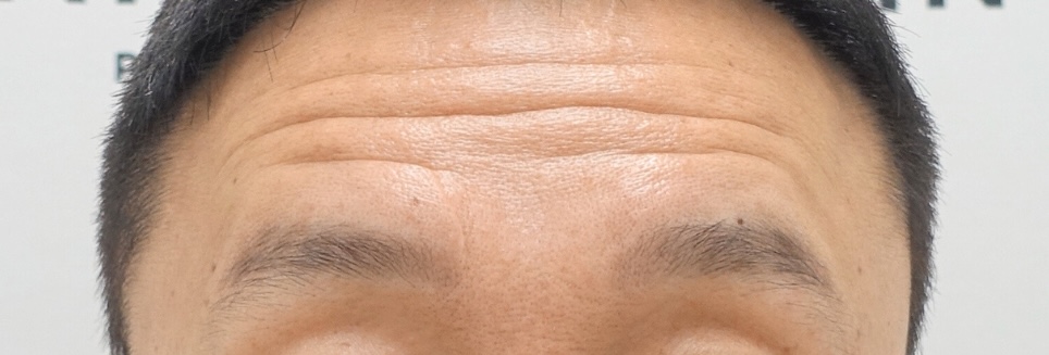 20대 남자 안검하수, 졸린 눈 어떻게 해결할까? 관련 이미지 2