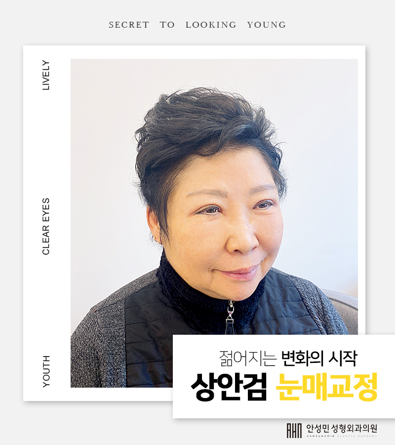 [잠실동성형외과] 젊음의비결! 중년층고객님들도 상안검눈매교정으로 눈가 주름 및  처짐개선 동안페이스 완성!! 관련 이미지 1