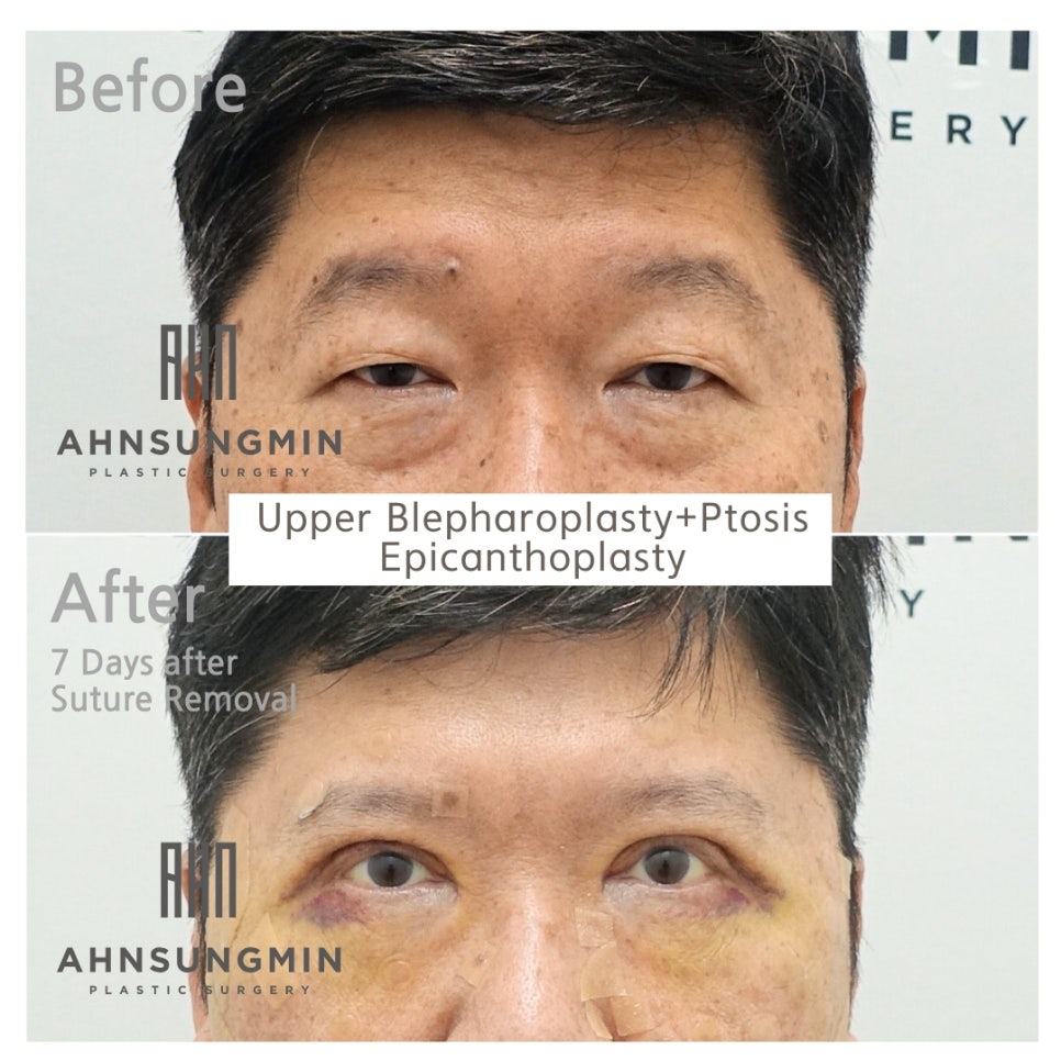 중년남성 진성안검하수 상안검성형[성형외과전문의] 관련 이미지 2