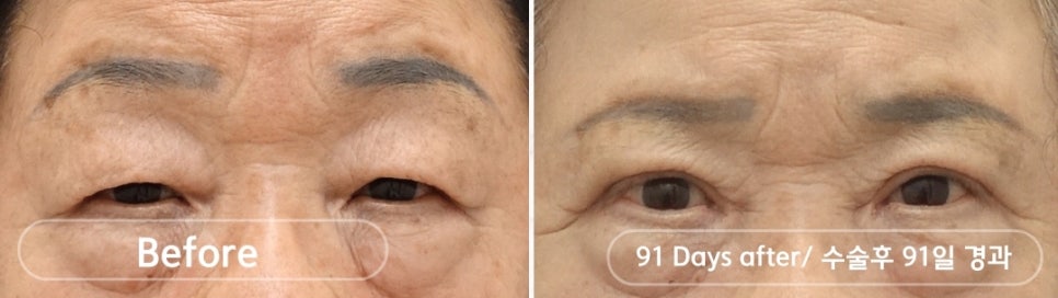나이대별 상안검 수술, 처진 눈꺼풀을 개선하다 관련 이미지 7