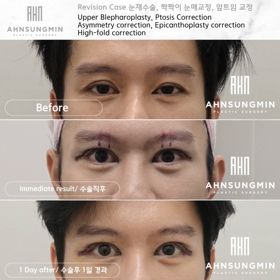남자 쌍꺼풀 재수술 눈매교정, 짝짝이 교정 잘하는 곳 안성민성형외과 관련 이미지 5