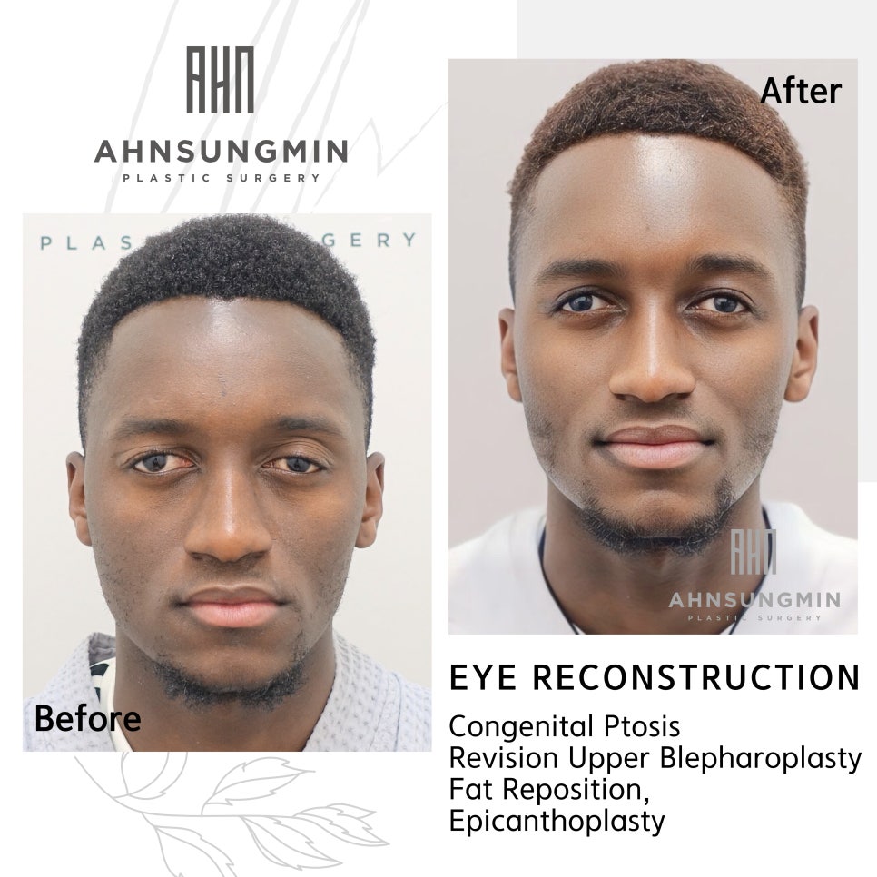 선천성 안검하수 재수술 짝짝이교정 관련 이미지 4