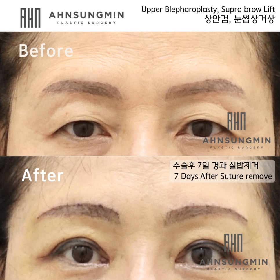 눈썹 상거상 수술이 필요한 이유와 눈썹 하거상 수술의 부작용 관련 이미지 2