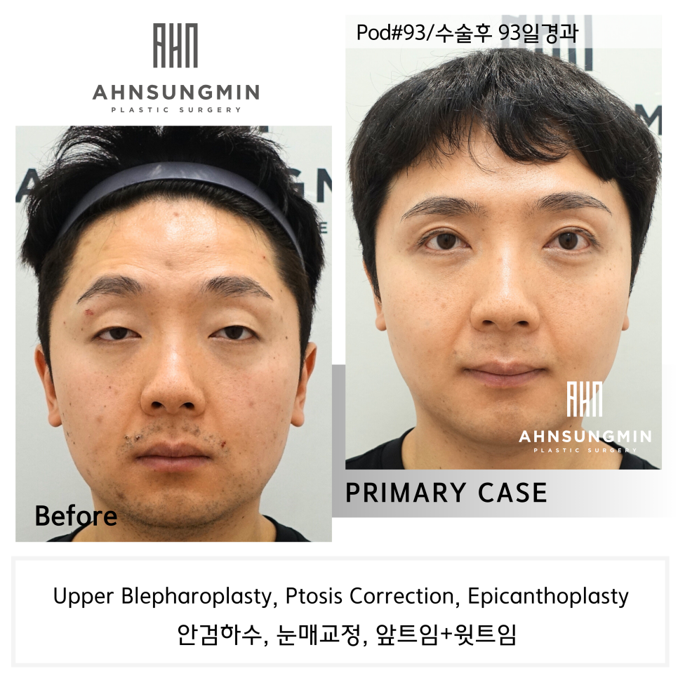 20대 남성 안검하수 증세와 눈매교정 수술 후 3개월 경과 관련 이미지 2