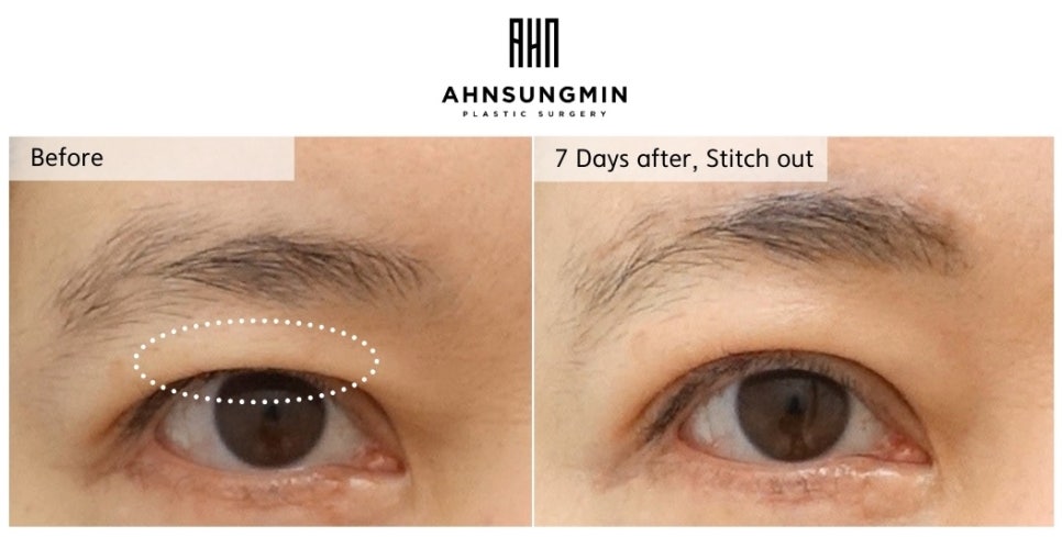 상안검 수술 후에도 답답하다면? 눈썹상거상으로 해결하는 방법 관련 이미지 1