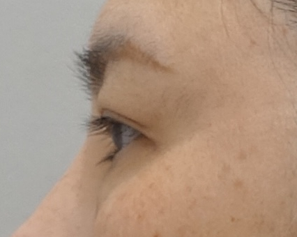 돌출눈 쌍꺼풀 수술이 가능할까? 관련 이미지 2