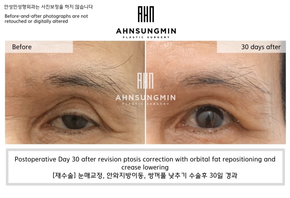 눈꺼풀 꺼짐, 왜 지방이식을 선택하지 않았을까요? 관련 이미지 2