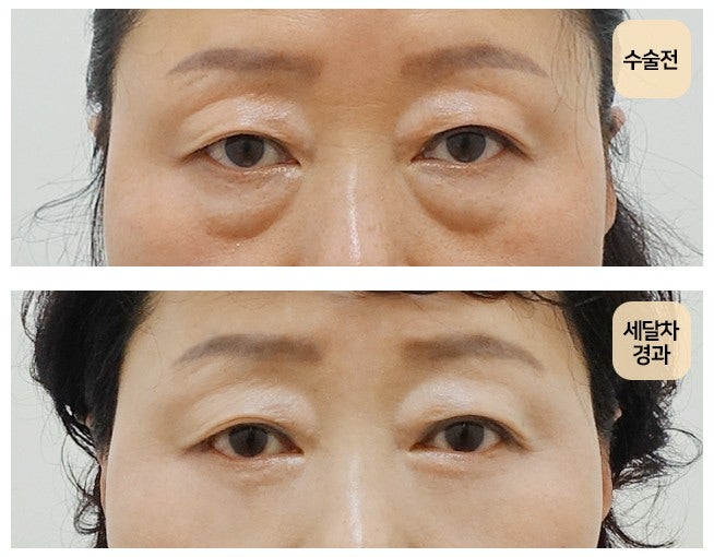 하안검 지방재배치 관련 이미지 3