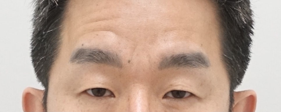 나이대별 상안검 수술 전후, 성형외과전문의 안성민 관련 이미지 9