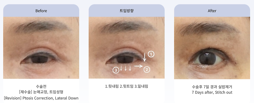 트임 성형의 모든 것 뒤트임, 뒷내림, 밑트임 관련 이미지 4