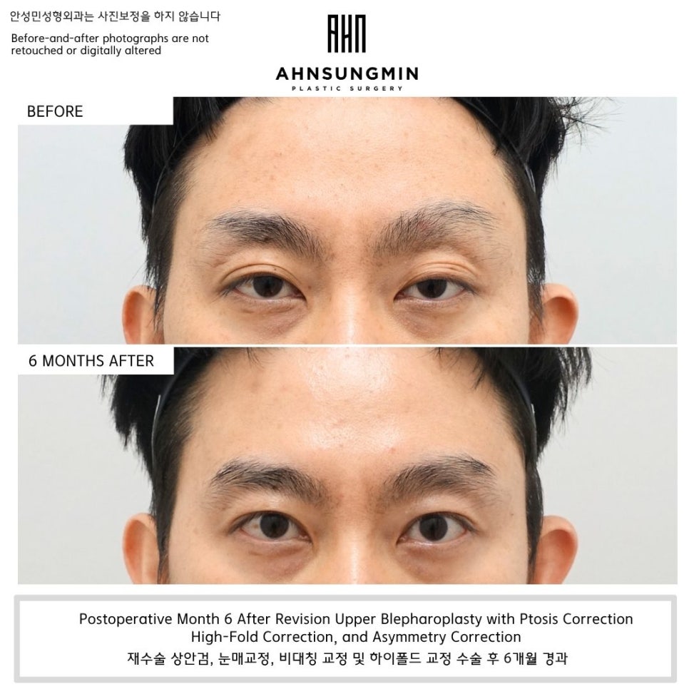 쌍꺼풀 재수술 후 눈은 언제 자연스러워질까? (Day 1부터 6개월 변화) 관련 이미지 1