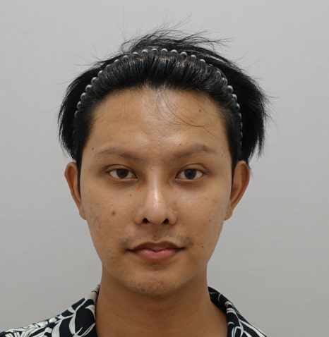 남자 쌍꺼풀 재수술 눈매교정, 짝짝이 교정 잘하는 곳 안성민성형외과 관련 이미지 4