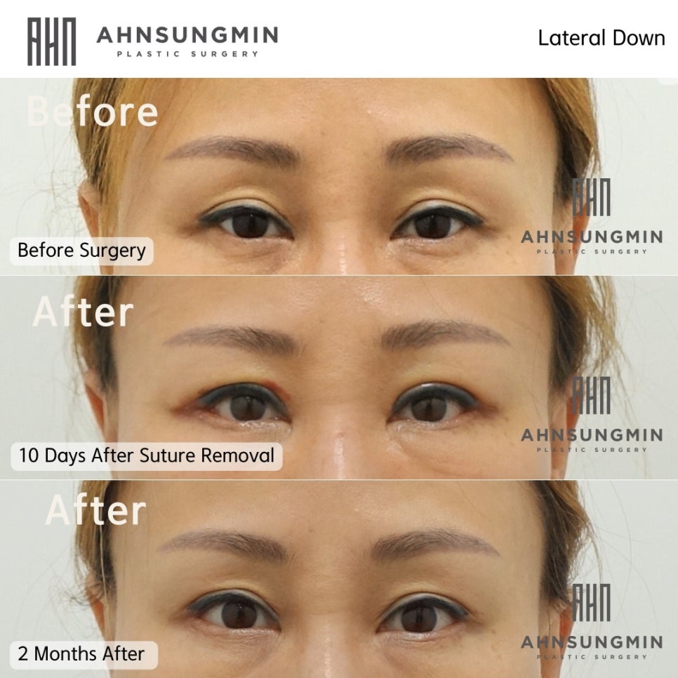 눈밑트임 뒷트임과 뒷내림 [성형외과 전문의 안성민] 관련 이미지 2