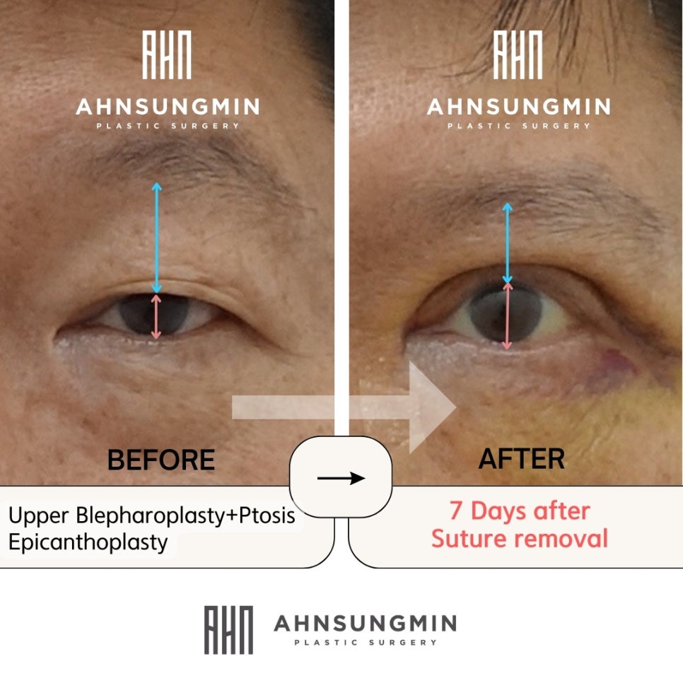 중년남성 진성안검하수 상안검성형[성형외과전문의] 관련 이미지 4