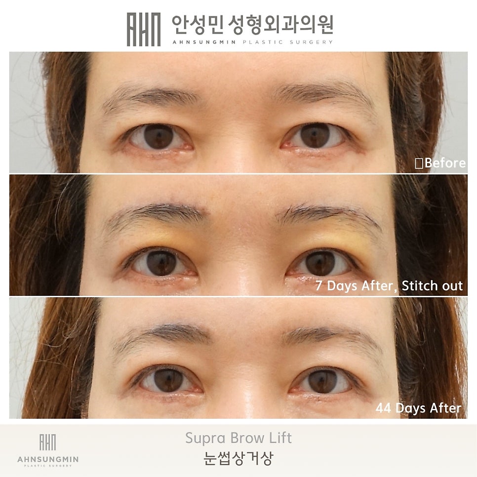 눈썹 거상 수술 흉터와 회복 과정 관련 이미지 7